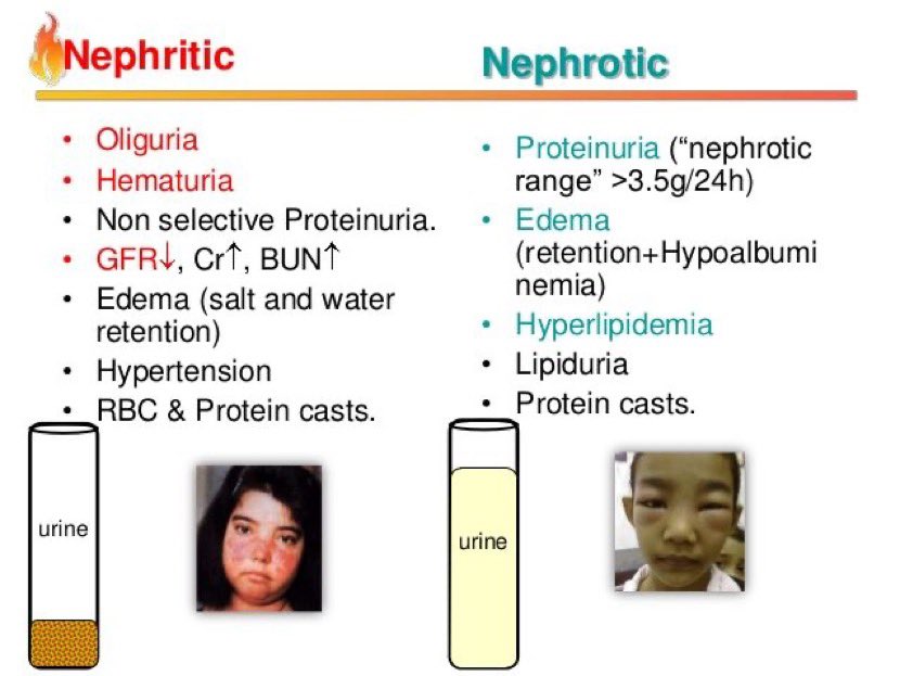 __mnemonics's tweet photo. nephrotic vs nephritic syndrome 🤩: 

#nephrology 
#medicine https://t.co/5aupE0DRSh