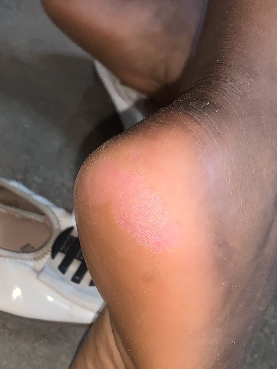 samuelejumudo's tweet photo. 10yo boarding student came in with a history of rats nibbling the soles of her feet as well as those of other girls in her school 🥹🥹

Ebonyi! The gift that keeps giving.
#CorperChronicles
#MedTwitter https://t.co/soetixUF6Q