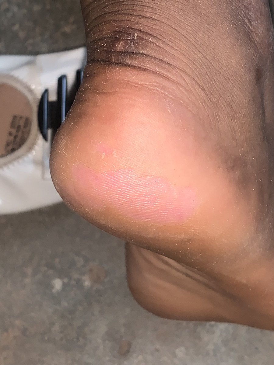 samuelejumudo's tweet photo. 10yo boarding student came in with a history of rats nibbling the soles of her feet as well as those of other girls in her school 🥹🥹

Ebonyi! The gift that keeps giving.
#CorperChronicles
#MedTwitter https://t.co/soetixUF6Q