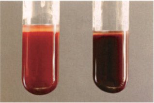 Endoscopy patient Benzocaine spray used for throat analgesia Post procedure shortness of breath Chocolate brown blood Diagnosis? Treatment?