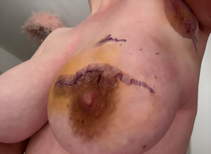 4 days post breast cancer surgery!! 💖 https://t.co/uIKXm8jMC6