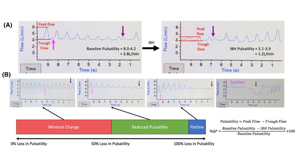 ArtifOrgans's tweet image. Using #Pulsatility responses to breath-hold maneuvers to predict #Readmission rates in continuous-flow #LVAD patients👇
tinyurl.com/y829yrtw
@Svphs🇦🇺| @Anju_ramanayake #Outcomes #PulsatilityResponse