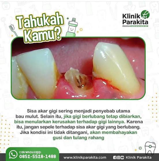 winz_valentinj's tweet photo. halo yg GIGI BAWAH  nya ada yang kondisi seperti ini, sisa stgh dan ingin di cabut, boleh dm saya ya, terima kasih! perawatan nya gratisssss! https://t.co/C7hBMdDAPN