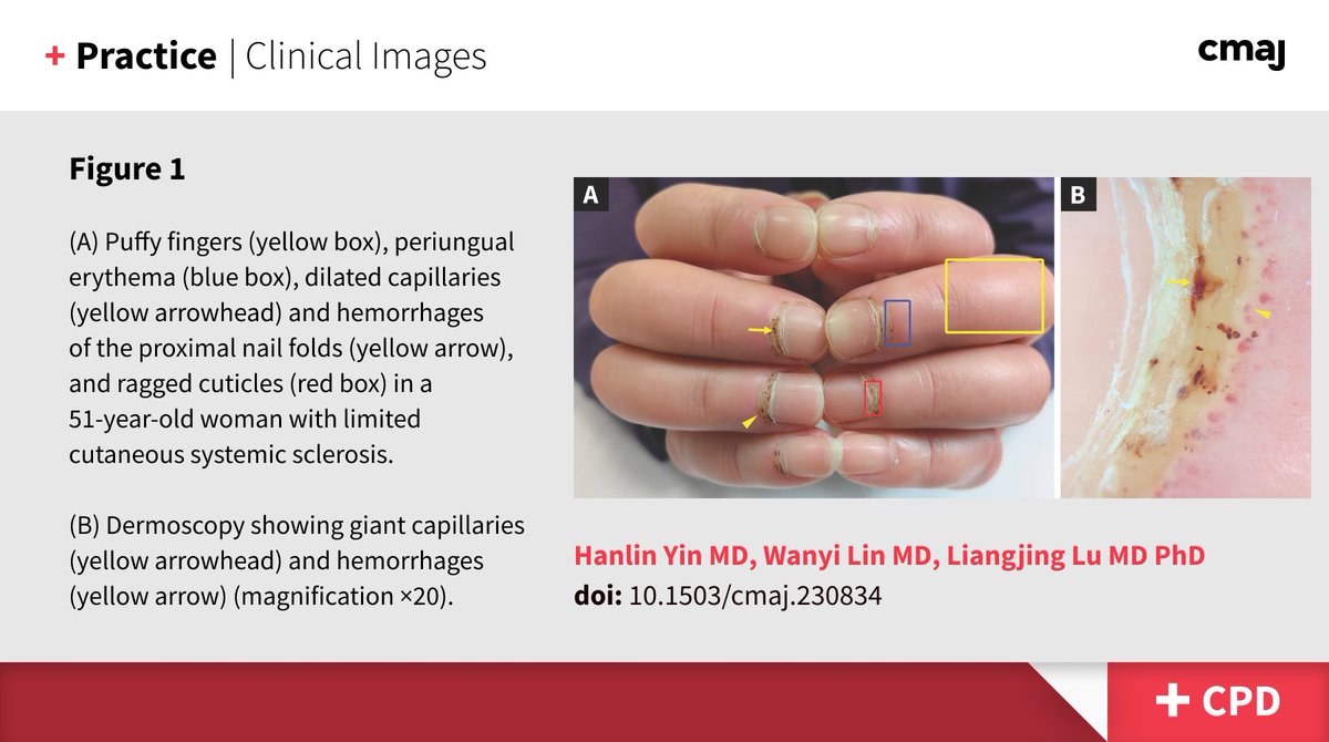 hanlinyinMD's tweet photo. @Janetbirdope Perhaps the nailfold abnormalities are more clearly shown in this image for your reference.😉 https://t.co/LJmnt25fnN https://t.co/w2r770bAPG