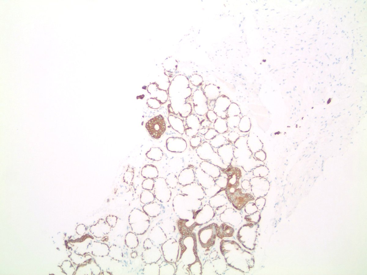 Prostate - Cowper glands #PathTwitter #GUPath #PathOutPic [2] 34βE12