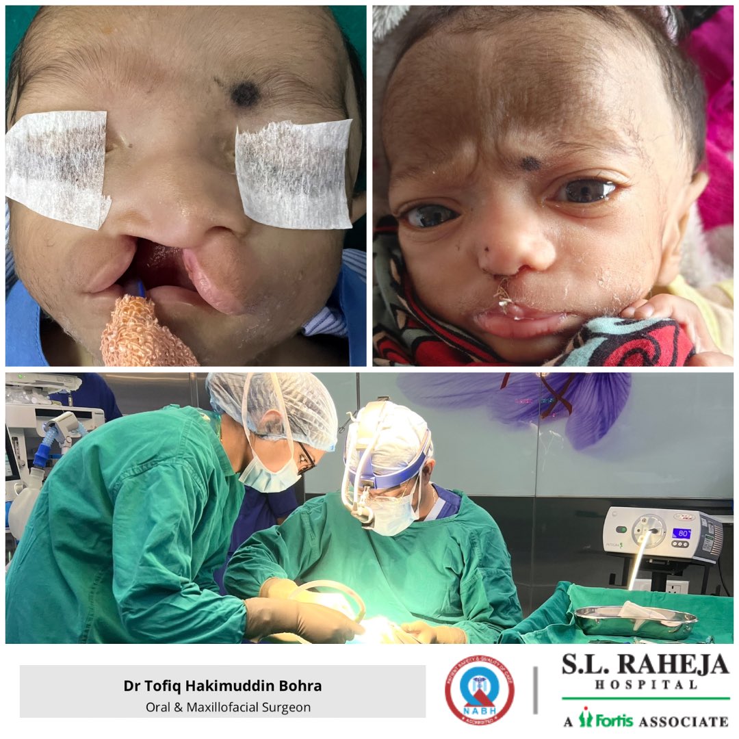 #cleft #cleftstrong #cleftlip #cleftliprepair