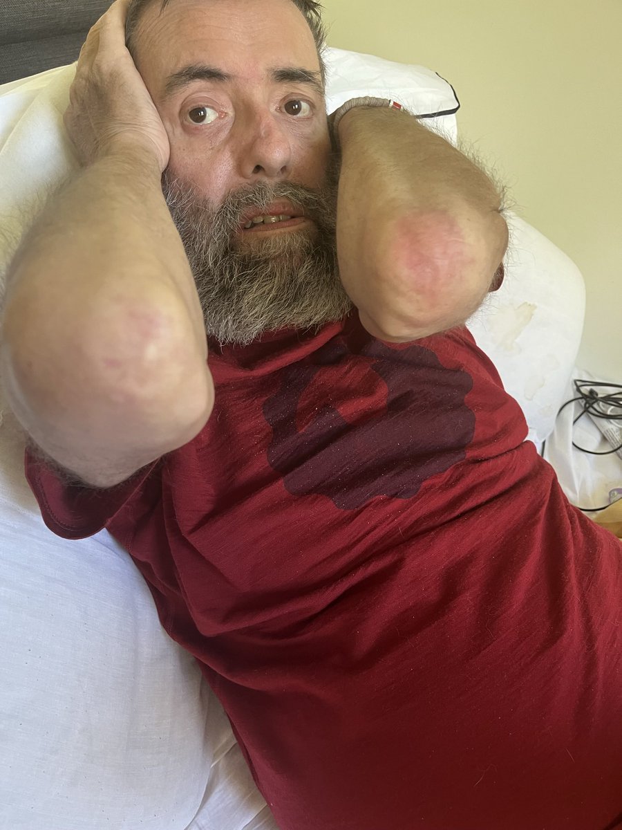 Feel like crap, been bleeding all night, going from dehydrated, constipated to shitting myself. Cancelled my week away as I can’t leave the bed (hence shitty grunties.

No dignity no doubt