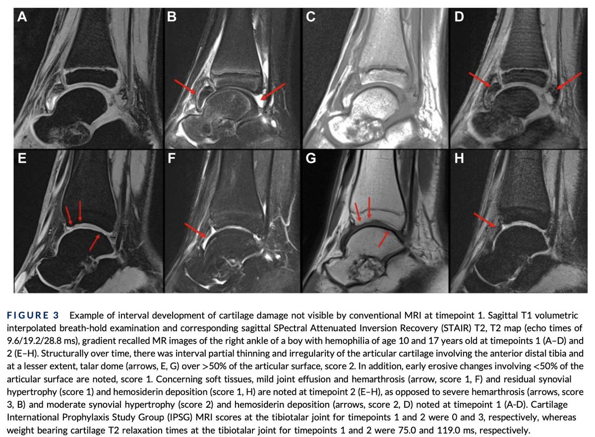 Hemarthrosis often results in irreversible arthropathy in patients with #hemophilia. Prelim results reveal that T2 mapping MRI reflect changes may indicate cartilage damage prior to conventional MRI, showing prognostic potential. bit.ly/3ZVpF0v #RPTH