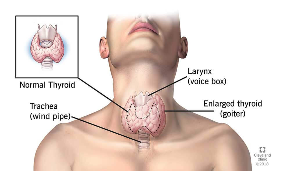 IpshaNur's tweet photo. Hypothyroidism(Underactive Thyroid)Everything U Need to Know.see more.https://t.co/2hHERjzQXo #OfficialTwitter #Uniswap #MondayMotivation #MondayMood #Giants #Ripple #IsraelGazaWar #NewWeek #Bills #FHRoyal_TWJxMileAp #ジャニーズ事務所ありが #杉田さん #冒険少年 https://t.co/rgSWeNYsTI
