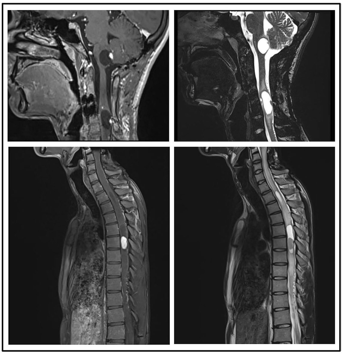 #Chek2 out our latest work on VHL Disease with a very severe course published today in @ActaNeuro 🧠📝

link.springer.com/article/10.100…