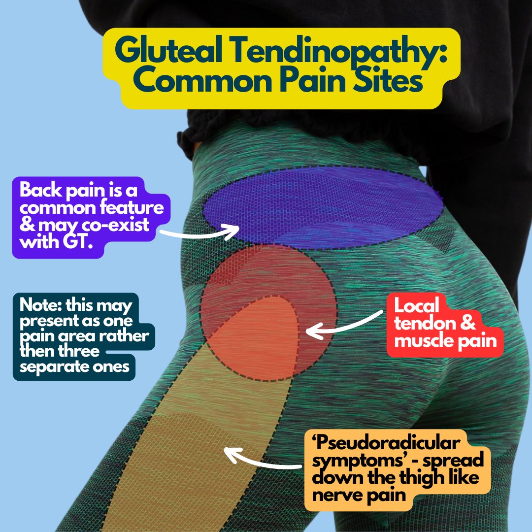 Common pain sites in Gluteal Tendinopathy...

Most tendinopathy in the lower limb has quite focal pain that rarely spreads. Think of the Achilles or Patellar tendons, for example. The Gluteal tendon is different! There is likely to be local pain over and around the tendon but