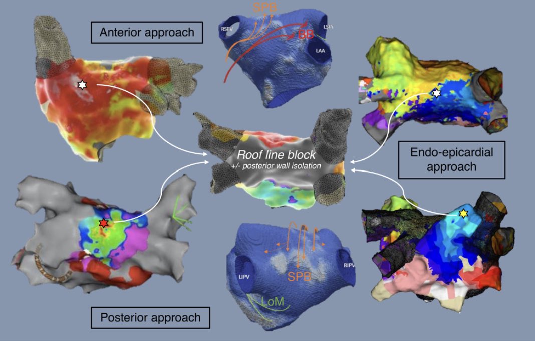 Europace Editor-in-Chief (@europaceeic) on Twitter photo 🔥🔥🔥
How to ablate the septo-pulmonary bundle: a case-based review of ablation strategies to achieve roof line block
📚 doi.org/10.1093/europa…
<a href="/GiulioConte9/">Giulio Conte</a> <a href="/Dominik_Linz/">Dominik Linz</a> <a href="/FraSantoroMD/">Francesco Santoro, MD, PhD</a> <a href="/marcovitoloMD/">Marco Vitolo Ⓜ️</a> <a href="/AndyZhangMD/">Xiaodong Zhang (Andy), MD, PhD, FHRS, FACC</a> <a href="/MBergonti/">Marco Bergonti</a> <a href="/LuigiDiBiaseMD/">Luigi Di Biase</a> 🔥🔥🔥
How to ablate the septo-pulmonary bundle: a case-based review of ablation strategies to achieve roof line block
📚 doi.org/10.1093/europa…
<a href="/GiulioConte9/">Giulio Conte</a> <a href="/Dominik_Linz/">Dominik Linz</a> <a href="/FraSantoroMD/">Francesco Santoro, MD, PhD</a> <a href="/marcovitoloMD/">Marco Vitolo Ⓜ️</a> <a href="/AndyZhangMD/">Xiaodong Zhang (Andy), MD, PhD, FHRS, FACC</a> <a href="/MBergonti/">Marco Bergonti</a> <a href="/LuigiDiBiaseMD/">Luigi Di Biase</a>