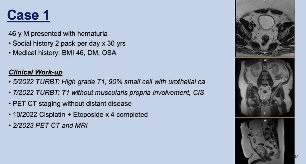 The complex case of a 46-year-old smoker with high-grade T1 #BladderCancer - <a href="/MattMossanen/">Matthew Mossanen</a> is joined by Jennifer Yates and <a href="/mouwlab/">Kent Mouw</a> to discuss a patient case, emphasizing the importance of a multidisciplinary approach &gt; bit.ly/3rQ4e4n <a href="/pfizer/">Pfizer Inc.</a> <a href="/UMassBoston/">UMass Boston</a> <a href="/DanaFarber/">Dana-Farber</a>