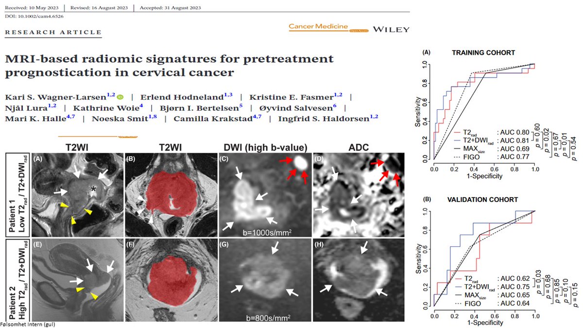 Ingfrid Haldorsen (@ingfridhaldors1) on Twitter photo Happy to share the study on #MRI #radiomics in women with #cervicalcancer by <a href="/KariWagnerLars1/">Kari Wagner-Larsen</a> <a href="/BergenMMIV/">MMIV</a>, <a href="/haukeland_no/">Haukeland</a> @medfak_uib: onlinelibrary.wiley.com/doi/full/10.10…
<a href="/SanitetKvinnene/">Sanitetskvinnene</a> <a href="/Gynkreft/">Gynkreftforeningen</a> <a href="/HelseVest/">Helse Vest</a> <a href="/forskningsradet/">Norges forskningsråd</a> & @mohnfoundation <a href="/AslakLaks/">Aslak Aslaksen</a> <a href="/FasmerKristine/">Kristine Fasmer</a> <a href="/Njaallura/">Njål Lura</a> @_Noeska_ Happy to share the study on #MRI #radiomics in women with #cervicalcancer by <a href="/KariWagnerLars1/">Kari Wagner-Larsen</a> <a href="/BergenMMIV/">MMIV</a>, <a href="/haukeland_no/">Haukeland</a> @medfak_uib: onlinelibrary.wiley.com/doi/full/10.10…
<a href="/SanitetKvinnene/">Sanitetskvinnene</a> <a href="/Gynkreft/">Gynkreftforeningen</a> <a href="/HelseVest/">Helse Vest</a> <a href="/forskningsradet/">Norges forskningsråd</a> & @mohnfoundation <a href="/AslakLaks/">Aslak Aslaksen</a> <a href="/FasmerKristine/">Kristine Fasmer</a> <a href="/Njaallura/">Njål Lura</a> @_Noeska_