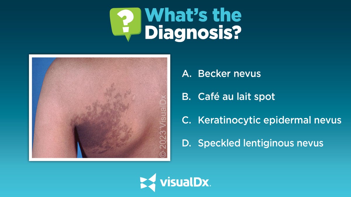 What’s the Dx? 16 yo boy w/ a back lesion that developed a few months prior. Exam: dark brown plaque w/ outlying associated lighter & smaller macules & patches were seen on the left back. No history of dermatological conditions & was not on any medications. Tell us your Dx!