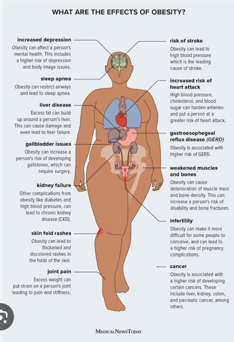 PiCoin140319's tweet photo. @plsLoveaintreal That's Obesity. Nothing to be proud of.

Go for Gym 🏋️‍♀️ 💪 to get rid of that excess fat. Remember to eat healthy.

https://t.co/37binGdRwF https://t.co/2xtDRYu4XG