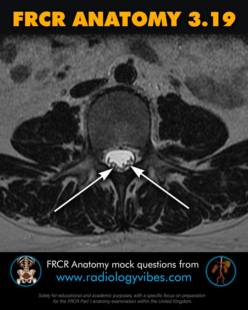 FRCR Anatomy 3.19: Name the arrowed structure #radres #FOAMrad #FRCR #radiology #anatomy #MedTwitter #radtwitter #FRCRanatomy @Radiology_Vibes @anatomy4frcr @_the_SRT