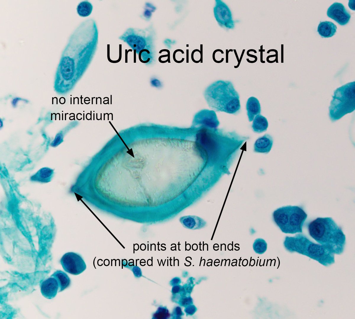 The answer to the #ParasiteCase 728 is now up: Uric acid crystals in urine– a tricky mimic of Schistosoma haematobium eggs! Read how to differentiate them here (and below): parasitewonders.blogspot.com/2023/10/answer… #mayopath #pathology #CrittersOnTwitter #PathBugs In brief: 1. Uric acid crystals…