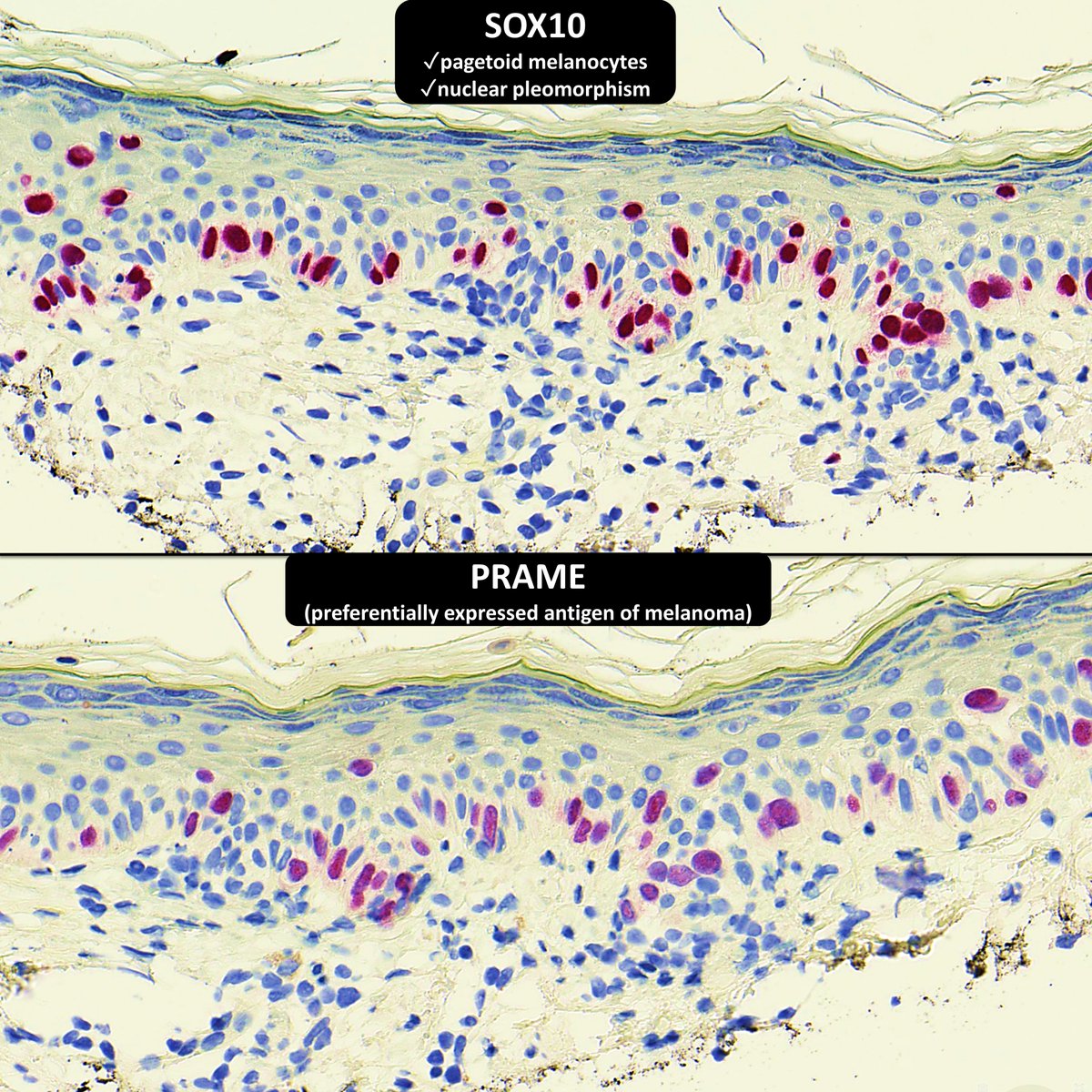 H&amp;E shows atypical &amp; pagetoid melanocytes
🔬kikoxp.com/slides/public/… 

SOX10 confirms melanocyte population with pleomorphic nuclei &amp; pagetoid spread
🔬kikoxp.com/slides/public/…

(➕) PRAME supports malignant transformation
🔬kikoxp.com/slides/public/…

Answer: True, it is melanoma‼️
