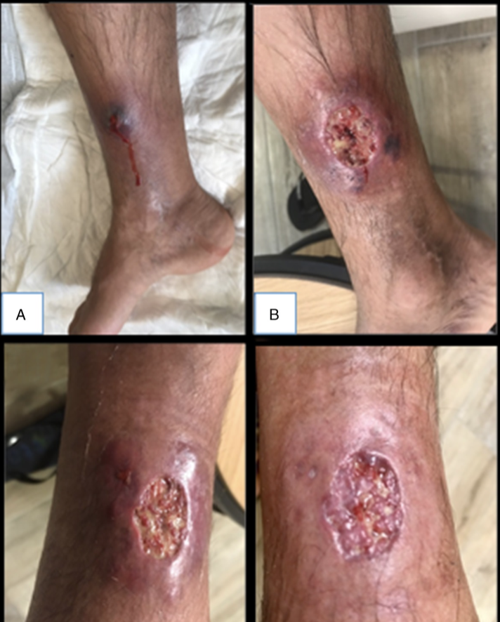 JRheumatology's tweet photo. #Infliximab and #Pyoderma Gangrenosum in IBD
https://t.co/JD0Vxz6rZS https://t.co/CWdQ3EXCUp