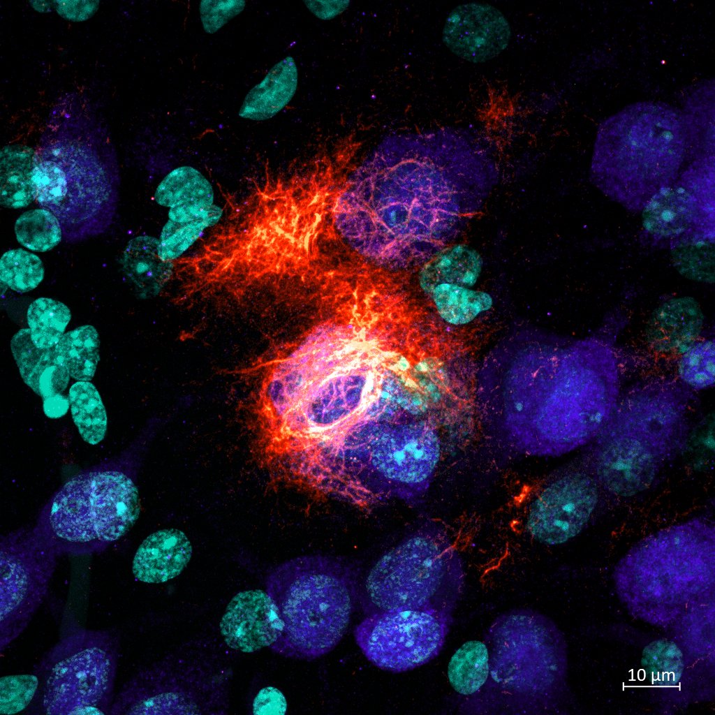 Happy #MicroscopyMonday with good news, the CMS, the U.S. national health insurance program, expanded coverage of amyloid PET scans, removing the limitation of one scan per lifetime. cms.gov/medicare-cover…
The image below shows the beginning of amyloid accumulation in the brain!