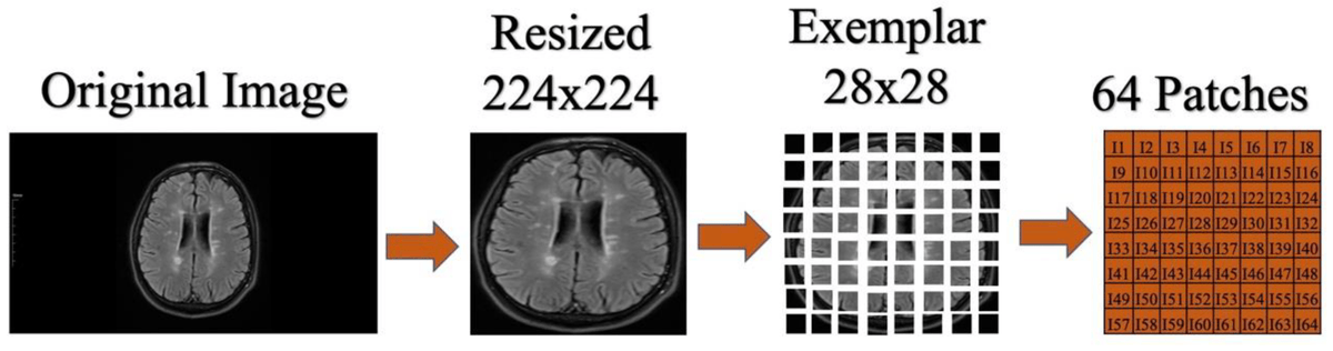 Who needs neurologists and radiologists? This study found artificial intelligence is >99% accurate in diagnosing multiple sclerosis based on interpretation of MRI images by MobileNetV2 networking with exemplar-based learning. pubmed.ncbi.nlm.nih.gov/37835771/