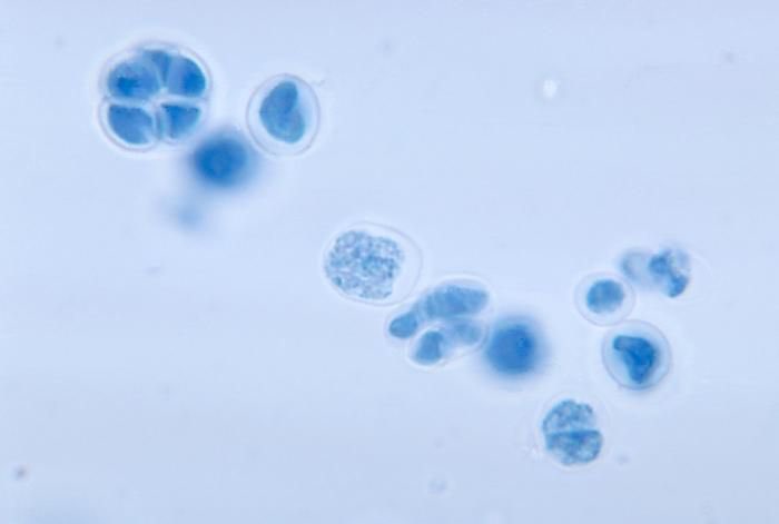 noufkmag's tweet photo. Mystery case discussion @IDWeekmtg by the @IDSAInfo fellows subcommittee moderated @pascalisID &amp; @RazonableMD 

Prototheca wickerhamii is achloric algae found in soil &amp; contaminated water. It causes a cutaneous hyperkeratotic maculopapular eruption &amp; olecranon bursitis #MedMicro https://t.co/VkHYiVuEpJ