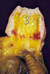 HalfBakedVet's tweet photo. 📙What's your suspected diagnosis❓
💥Case History: (Birds flock🐔)
 -Sudden onset  perfuse watery diarrhea, picking of vent &amp; weakness.
-Samples &amp; PM Examination shows lesion in the bursa ( picture 1 before opening of bursa ) &amp; (picture 2 after opening of bursa) ,
👇Read! https://t.co/RGPLSHExWz