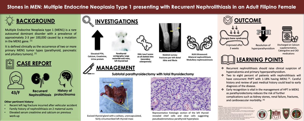 uppghnephrology's tweet photo. Interesting discussion yesterday about #MEN1 in a Filipino female presenting with recurrent nephrolithiasis! 😁😁😁

Case, topic discussion, and VA by our fellow, Dr. Robbie Velez! 👏🏻👏🏻👏🏻

Our guest consultant was none other than Dr. Mark Sandoval! 😆😆😆 https://t.co/jX3pxbz7mW