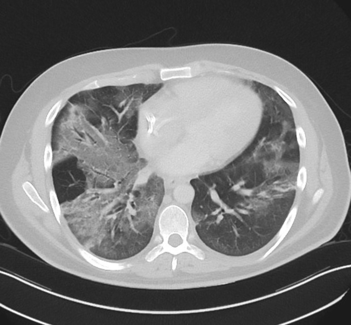 56, ♂️, Day +70 post haplo for AML

-high grade fever
-Shortness of breath 🫁 😭

You get a CT and see this 👇🏻

What's the ddx at this time point?
Management?

#MedTwitter #TransplantTwitter