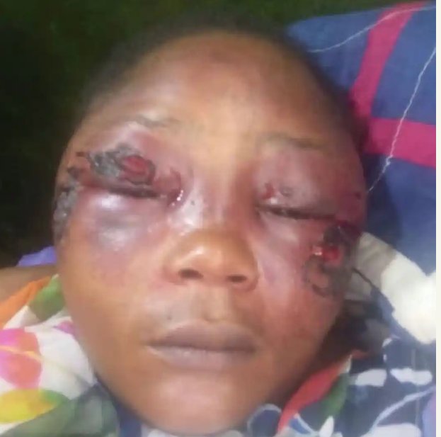 ONE-CHANCE ROBBERY: A Gang of Alleged One-chance Robbers Attack Woman With Spanner In Abuja. She was reportedly robbed, kidnapped and brutally beaten with a spanner by a suspected ‘one chance’ criminal gang in Abuja.

GORY PICTURES 👇
#abuja
#lindaikejiblog
#onechance