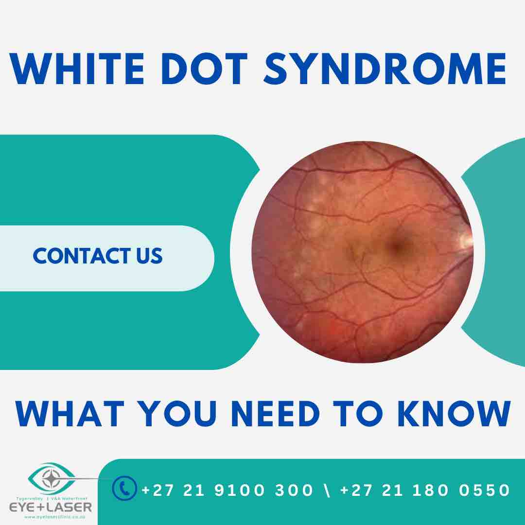White Dot Syndrome (WDS) is a common eye condition that affects the cornea, the clear front part of the eye. It is characterized by small, white dots that appear on the cornea. WDS is usually harmless and goes away on its own within a few weeks or months.