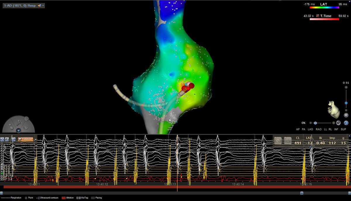 Pask_27's tweet photo. Nice case with @aportasanchez . Female, 82 years old, no structural heart disease. Incessant focal AT originating from the lateral wall of right atrium. LAT map with PENTARAY, 2 burns and she was gone. #keepongrowing @hospitalclinic #EPeeps #CARTO #ablate https://t.co/TuEEtfcu5k