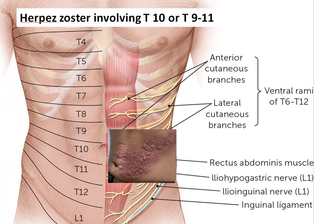IhabFathiSulima's tweet photo. #Herpes_Zoster/ #Shingles. involving #T_10 or #T_9_11
#dermatomes. https://t.co/cTYK5mG9sQ