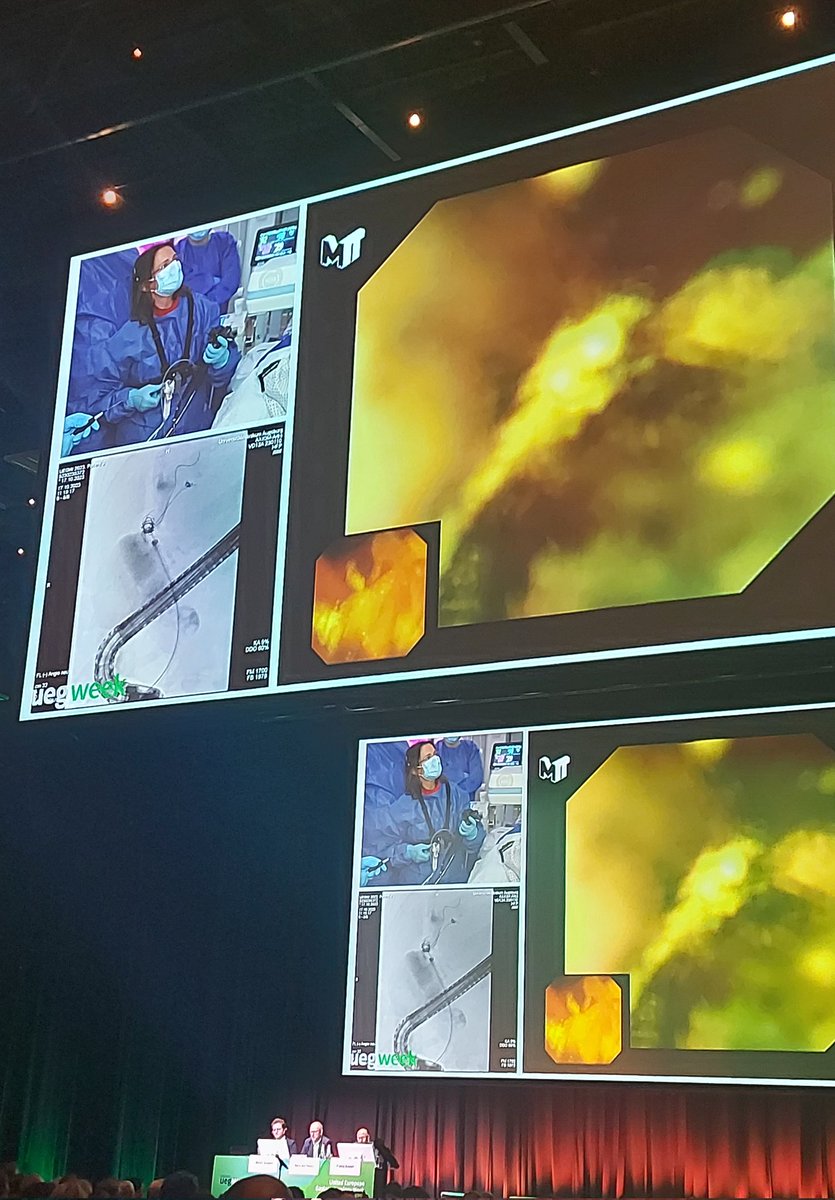 SN_gastro's tweet photo. Marianna Avranitakis, rocking ๐ธ ๐ค the huge ๐ชจ in the bile duct. A true super ๐ and a role model in #endoscopy. I'm glad to see women in live endoscopy at #UEGWeek @my_ueg #WomanInGI @WomeninEndo https://t.co/dfC8pKZdhA