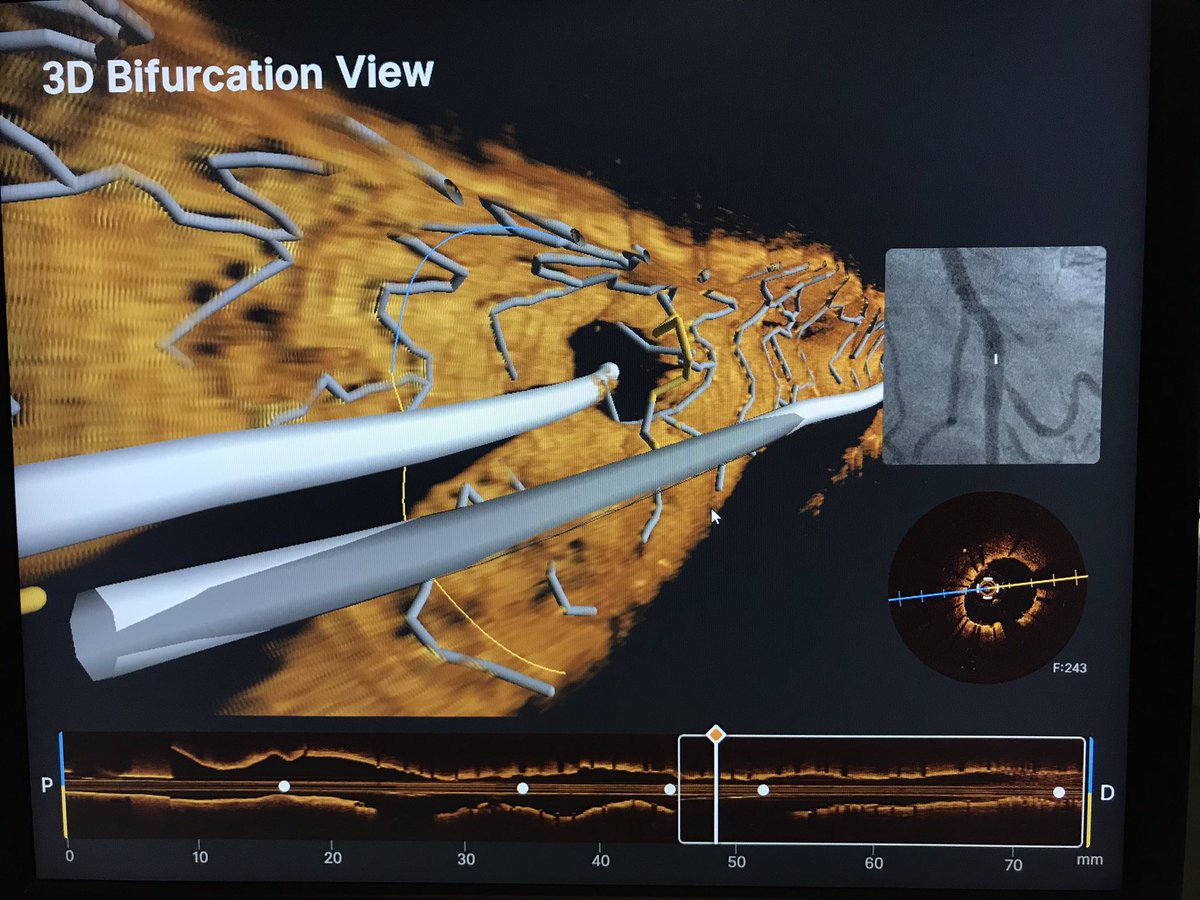 morrethound's tweet photo. Usefulness of intravascular imaging with #OCT and the new Ultreon 2.0 AI-powered software. Beautiful 3D vessel reconstruction depicting stent struts just in front of the side branch allowing correct rewiring, device crossing and kissing balloon for bifurcation treatment! https://t.co/vLxheUPPh9
