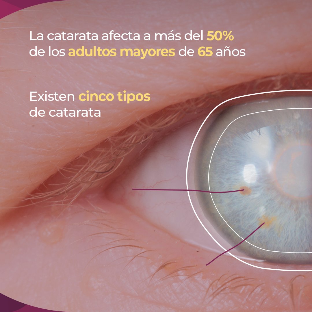 HospitalApec's tweet photo. Tu visión es nuestra pasión. Nuestro objetivo es combatir la ceguera en México y darles un mejor futuro a nuestros hijos. #APEC #NoMasCatarata #HospitalAPEC https://t.co/Wc55UW8yj1
