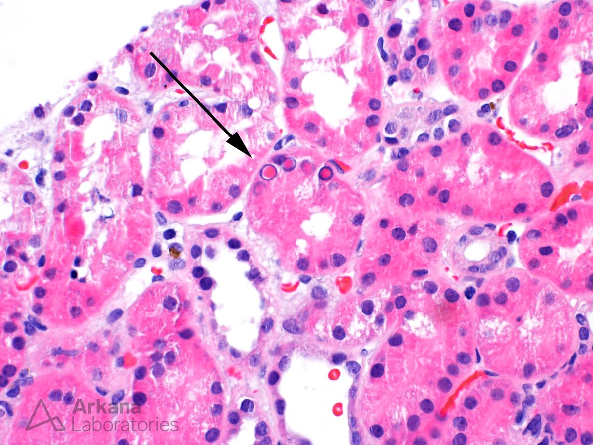 arkanalabs's tweet photo. For today's #TeachingPoint, we'll be looking at lead toxicity and its effects. The arrow in this image points to a cluster of tubular epithelial cells whose nuclei contain eosinophilic intranuclear inclusions characteristic of acute lead nephrotoxicity. In addition to inclusions, acute nephrotoxicity from lead and other heavy metals (e.g. platinum, mercury, gold, copper, iron, and lithium) is usually associated with morphologic features of acute tubular injury. As with all suspected cases of heavy metal toxicity, clinical correlation to assess for recent or past heavy metal exposure is required for an accurate diagnosis. In cases of chronic lead exposure, especially to low lead levels, the relationship between exposure and chronic kidney disease or end-stage renal disease (ESRD) has been debated. In a recent study, Evans et al. found no statistically significant difference in the incidence of ESRD among a large cohort of workers with documented lead exposure compared to a control group over a twenty year period (see reference below).
Evans M, et al. End-stage renal disease after occupational lead exposure: 20 years of follow-up.
Occup Environ Med. 2017 Jun; 74(6):396-401.