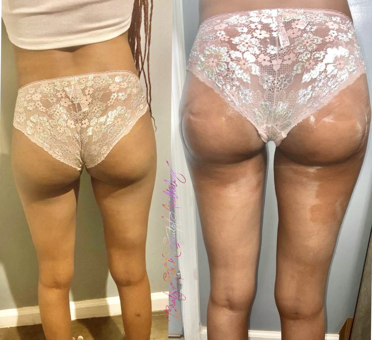 5starBarbx's tweet photo. 4 Area Vaccum Therapy Butt lift 💕 
Client: 1/8 sessions in , 8 sessions required for Ultimate results!
Book : Bratz Spa N Sculpt
Traveling Aesthetician 🚫💉 https://t.co/uTZEES0bjf