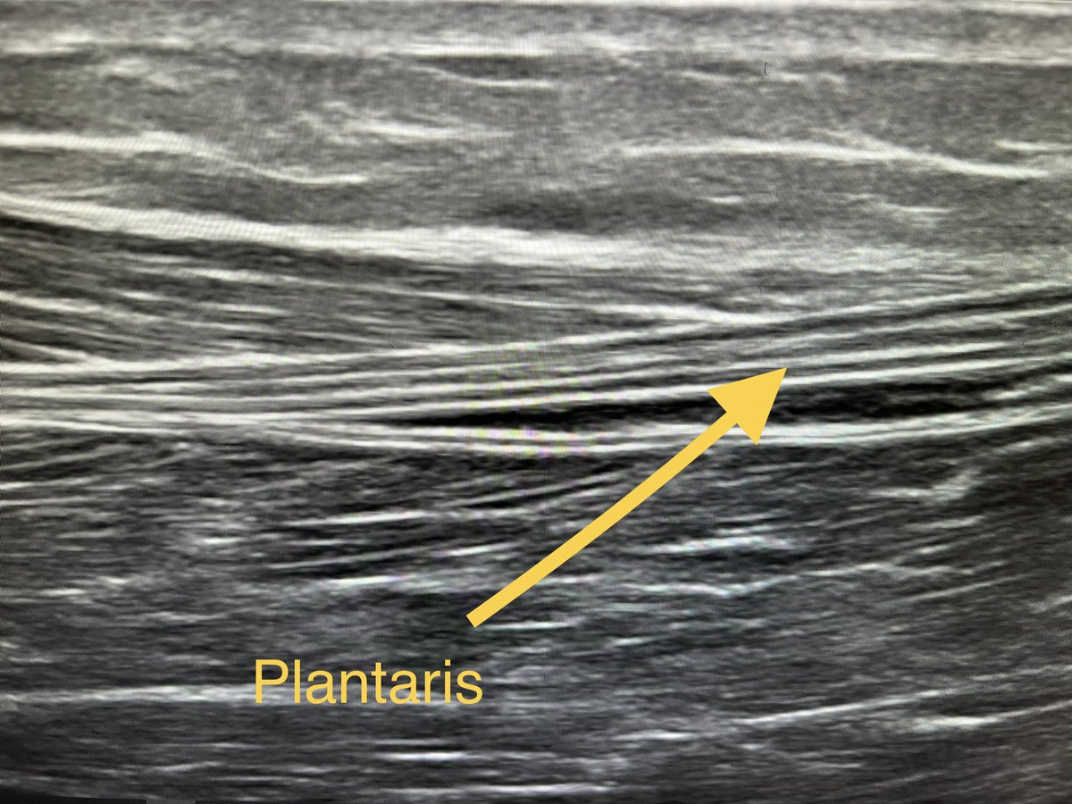 In medial achilles tendinitis which have a compressive plantaris component, hydrodissection or “stripping” of the plantaris tendon under US can help remove painful adhesions. 

You can then trace plantaris proximally up to the MTJ to see it has been dissected away properly.