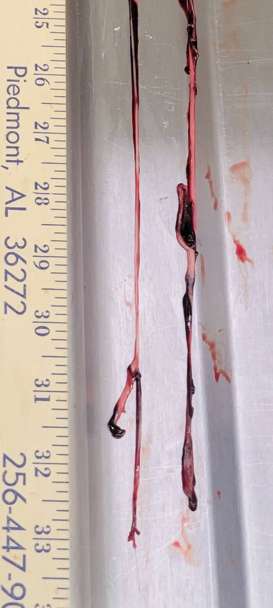 <a href="/MakisMD/">William Makis MD</a> <a href="/twc_health/">The Wellness Company</a> I pulled out a 33 inch one out of the iliac/femoral artery prior to embalming. Another embalmer showed me one 27 inches long. And yesterday another mortician showed me a 16 inch clot. Both found them from the iliac/femoral artery prior to embalming. Strange isn't it? But what do