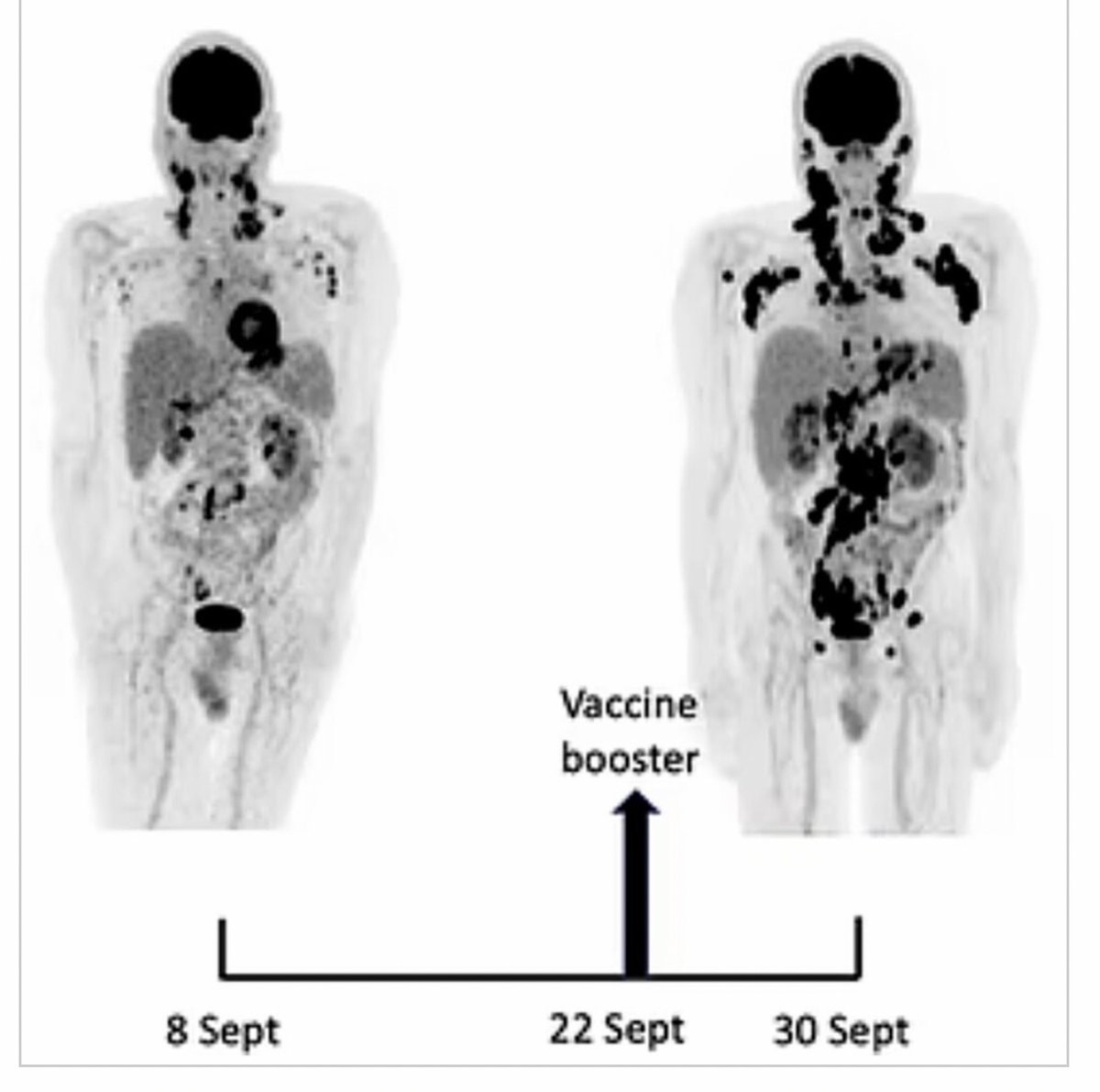 @justinkeister5 @bijoux144 @CartlandDavid @lukner End of September 2022, The Atlantic featured the story of Belgian immunologist Michel Goldman, 67, who in the spring of 2021 got his first and second COVID-19 shot. In the fall of that year, he was diagnosed with lymphoma, cancer of the immune system. frontiersin.org/articles/10.33…