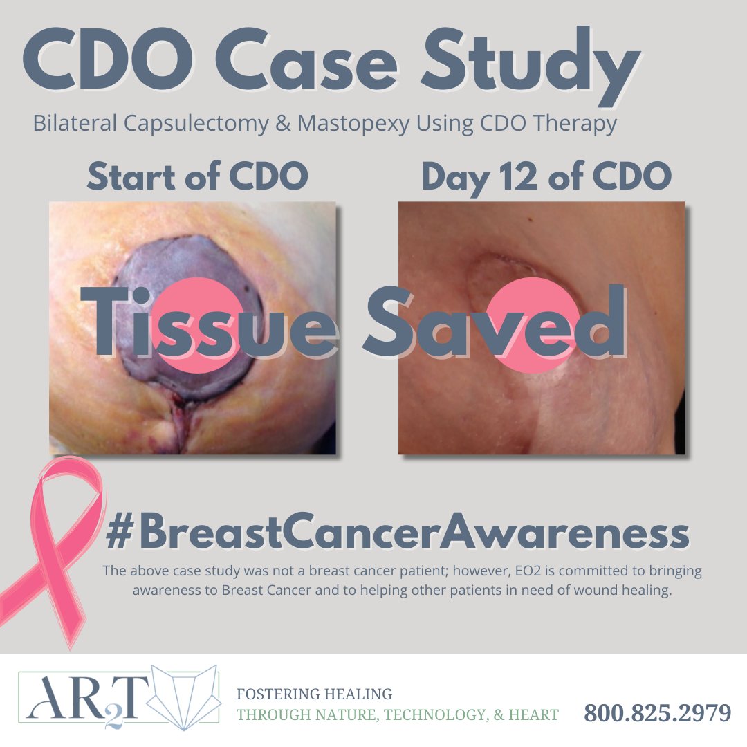 ar2teo2's tweet photo. This patient was not a #breastcancer patient; however, EO2 is committed to spreading awareness and to helping all patients with a troublesome wound.

See how 24/7, Portable Oxygen Therapy helped heal this wound in 12 days: https://t.co/0ZO6bGheX7

#breastcancerawareness https://t.co/5vULfbpE7O