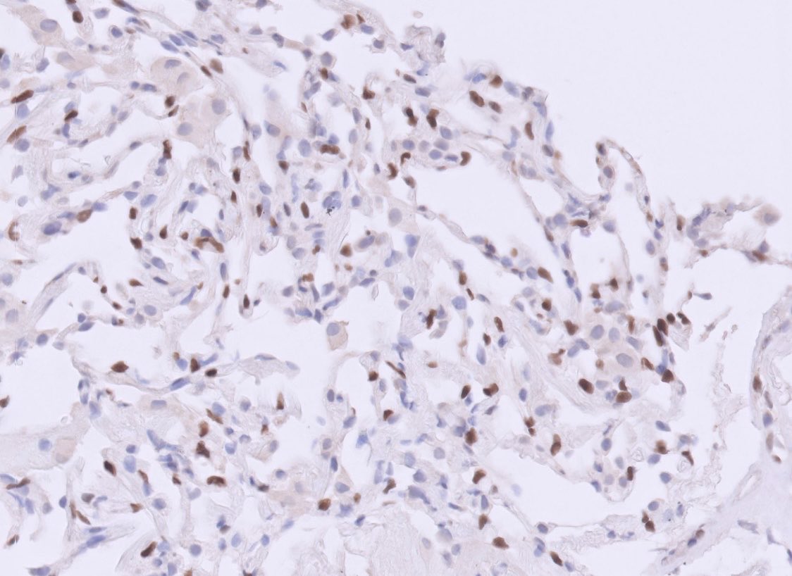 Pt has history of mullerian malignancy. What stain is this, highlighting the endothelial cells? (Hint: it’s not ERG) #pathtwitter #surgpath #gynpath #lungpath #pulmpath #thoracicpath #pathology #pathologists #ihc #immunohistochemistry