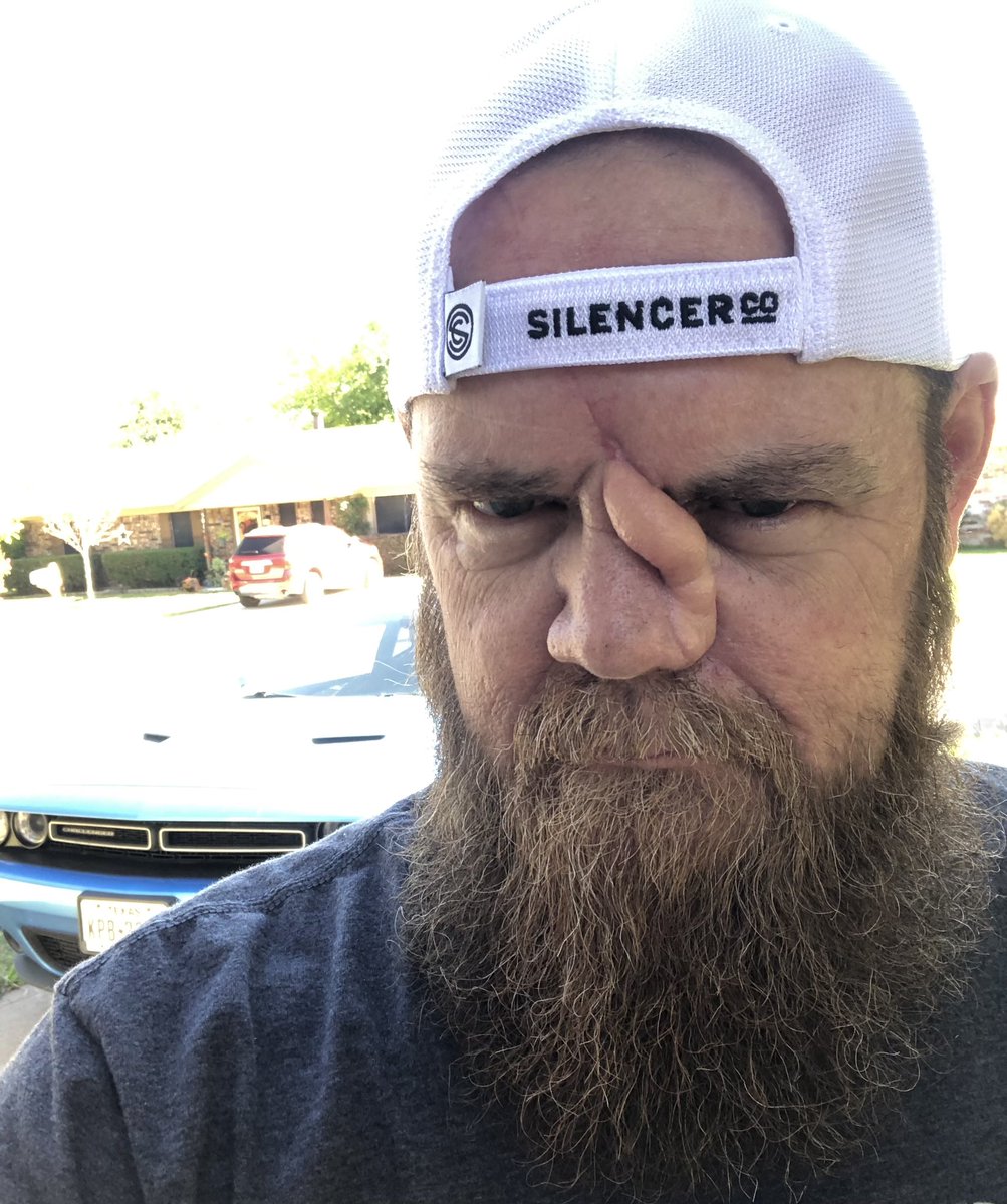 KlintEdwards's tweet photo. In other news. It’s been 65 days since my repair surgery. Next surgery is November 9th. #skincancerawareness #skincancer #plasticsurgery #symptomofbeinghuman #Healing #LetsGo #BabyDollLeg #getup #instaface #mynose https://t.co/jV3qFaPCwQ https://t.co/fjM7E8rFqn