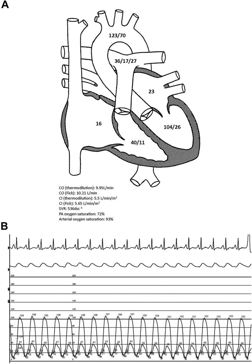 📑A case of high output heart failure diagnosed w simultaneous left & right heart catheterization #hemodynamics #JSCAIPearls ➡️doi.org/10.1016/j.jsca… @cooperbkersey @BarbaraADanek @CJChungMD