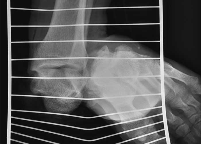 sportsfootankle's tweet photo. What are the symptoms of a #subtalar #dislocation?
· Fractures to the neighboring bones.
· Pain
· Deformity
· Swelling
· Tenderness
· Ankle deformity
· Inability to walk on the affected ankle
https://t.co/7x5GXXNagn #orthotwitter https://t.co/QLciwGim28
