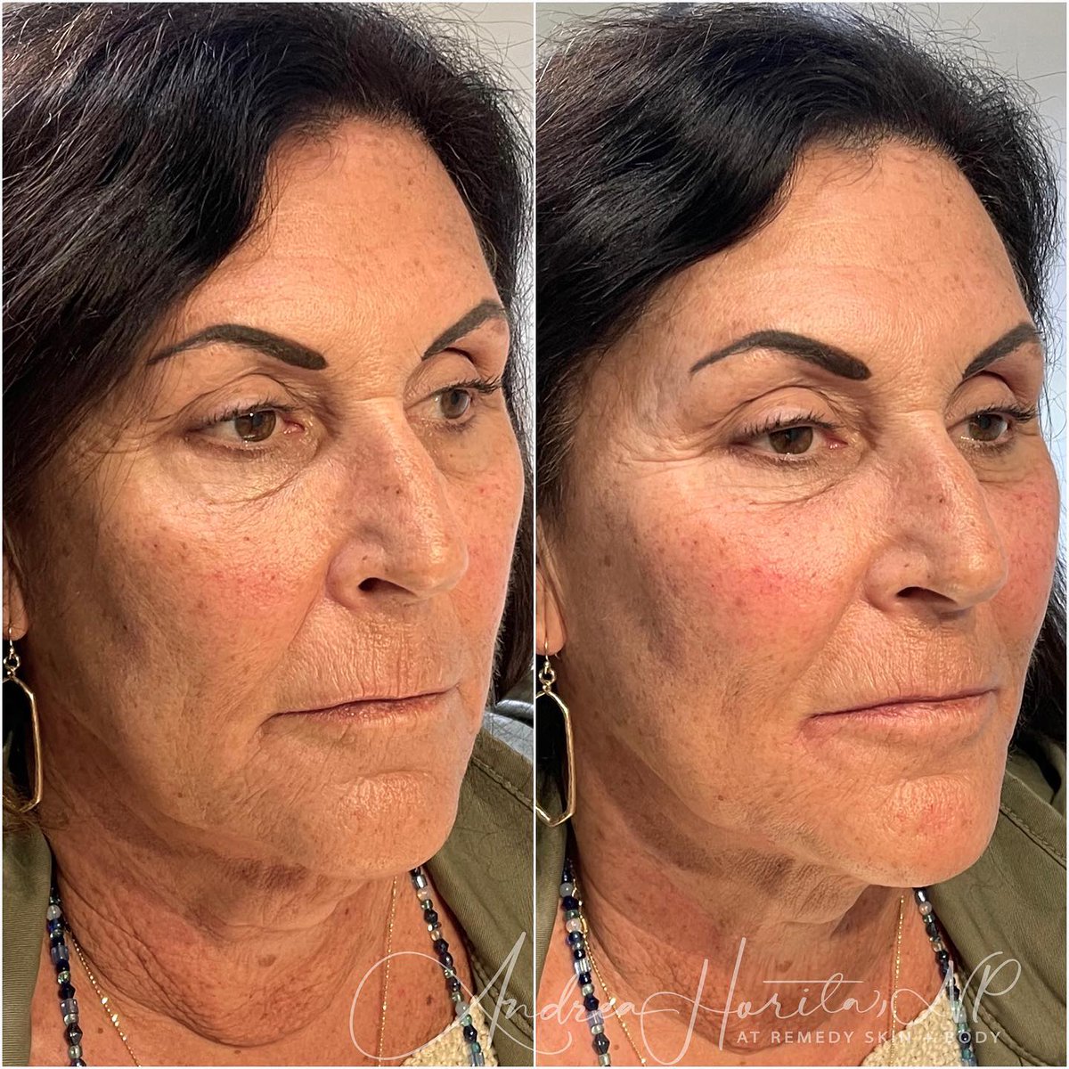 Remedyskinbody's tweet photo. We addressed her concerns of jowl laxity by providing deep support in the cheeks, lower jawline, and soft tissue transitional areas. The result? A softer, balanced, and refreshed look, reducing the appearance of jowls.

📷: @andreahorita_np https://t.co/KGY3juknsH