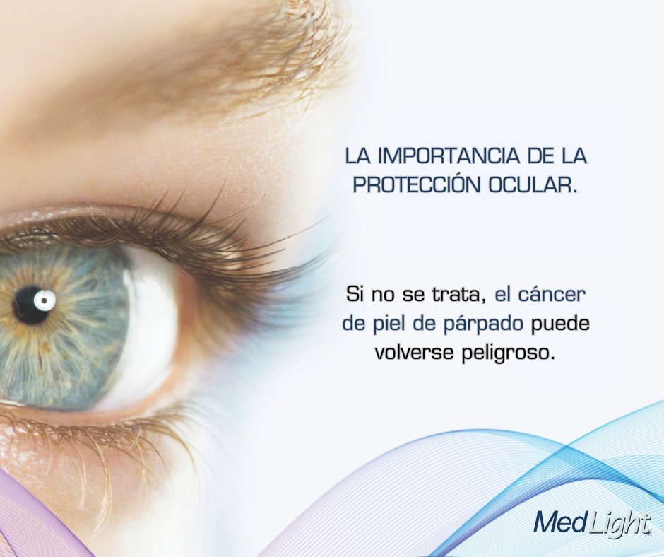 MedLightMD's tweet photo. Cuando se diagnostican a tiempo, los cánceres de párpado suelen responder bien a la cirugía, y el ojo  funciona intacto. Si no se tratan, pueden ser peligrosos y causar daños en los tejidos y ceguera.Cuide sus ojos con sombreros con UPF50+ y lentes.
#Medlight #UPF50 #cancerdepiel https://t.co/erZAhtoB81