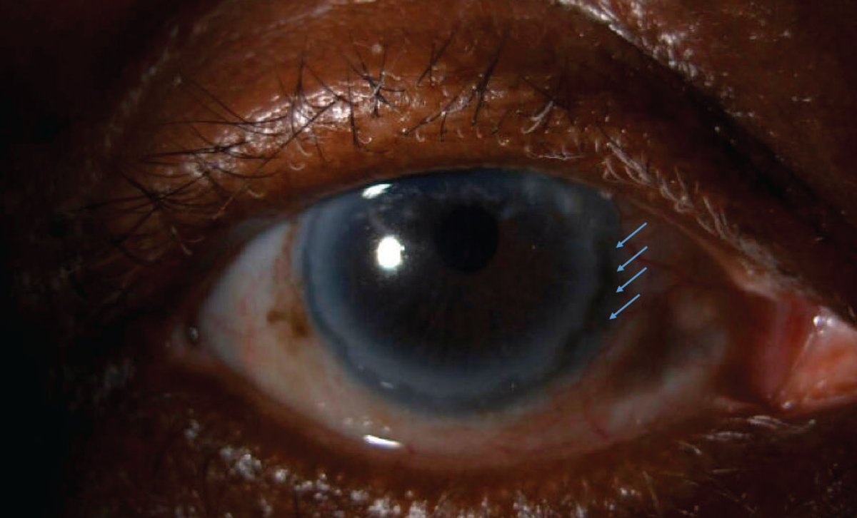 RevOphth's tweet photo. Treating Peripheral Ulcerative Keratitis
PUK is often more than meets the eye. Here’s guidance for managing these cases using two real-clinic examples: https://t.co/guZ6uum3Fy
#ophthalmology #eyecare #eyesurgeon #eyesurgery #eyedoctor #eyedoc #ophthalmologist #vision #cornea https://t.co/DXajhwcWNP